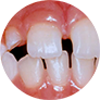 Аномалии размеров (слишком большие или маленькие зубы) и положения зубов