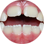 Открытый прикус (несмыкание передних верхних и нижних зубов)