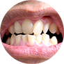 Скученность зубов (неправильное положение зубов в ряду, вызванном нехваткой места)