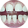 Тремы и диастемы зубных рядов (промежутки между зубами)