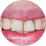 Неудовлетворительный внешний вид зубов